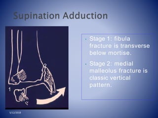 • Stage 1: fibula
fracture is transverse
below mortise.
• Stage 2: medial
malleolus fracture is
classic vertical
pattern.
1
2
5/12/2018
 