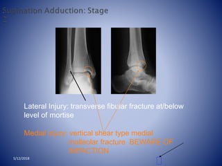 Lateral Injury: transverse fibular fracture at/below
level of mortise
Medial injury: vertical shear type medial
malleolar fracture BEWARE OF
IMPACTION
5/12/2018
 