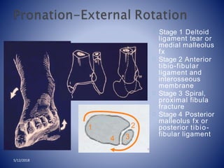 Stage 1 Deltoid
ligament tear or
medial malleolus
fx
Stage 2 Anterior
tibio-fibular
ligament and
interosseous
membrane
Stage 3 Spiral,
proximal fibula
fracture
Stage 4 Posterior
malleolus fx or
posterior tibio-
fibular ligament34
1 2
5/12/2018
 