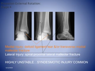 Medial injury: deltoid ligament tear &/or transverse medial
malleolar fracture
Lateral Injury: spiral proximal lateral malleolar fracture
HIGHLY UNSTABLE…SYNDESMOTIC INJURY COMMON
5/12/2018
 