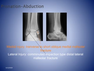 Medial injury: tranverse to short oblique medial malleolar
fracture
Lateral Injury: comminuted impaction type distal lateral
malleolar fracture
5/12/2018
 
