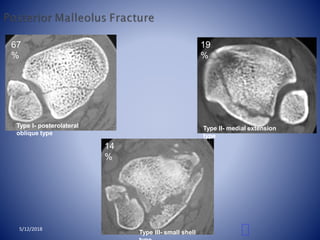 Type I- posterolateral
oblique type
Type II- medial extension
type
Type III- small shell
67
%
19
%
14
%
5/12/2018
 