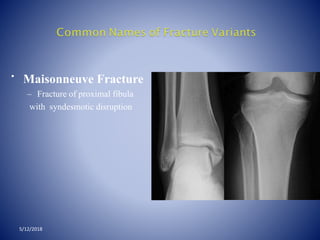 • Maisonneuve Fracture
– Fracture of proximal fibula
with syndesmotic disruption
5/12/2018
 