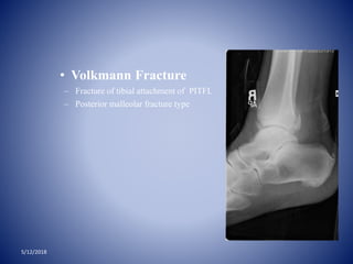 5/12/2018
• Volkmann Fracture
– Fracture of tibial attachment of PITFL
– Posterior malleolar fracture type
 