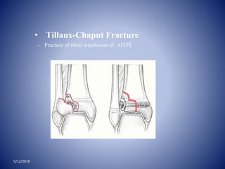 5/12/2018
• Tillaux-Chaput Fracture
– Fracture of tibial attachment of AITFL
 