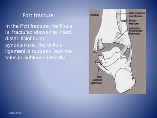 In the Pott fracture, the fibula
is fractured above the intact
distal tibiofibular
syndesmosis, the deltoid
ligament is ruptured, and the
talus is subluxed laterally
5/12/2018
Pott fracture
 