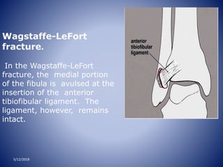 Wagstaffe-LeFort
fracture.
In the Wagstaffe-LeFort
fracture, the medial portion
of the fibula is avulsed at the
insertion of the anterior
tibiofibular ligament. The
ligament, however, remains
intact.
5/12/2018
 