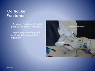 •Collicular
Fractures
–Avulsion fracture of distal
portion of medial malleolus
–Injury may continue and
rupture the deep deltoid
ligament
I
POSTERIOR
COLLICULUS
NTERCOLLICULAR GROOVE
ANTERIOR
COLLICULUS
5/12/2018
 