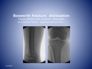 5/12/2018
•Bosworth fracture dislocation
–Fibular fracture with posterior dislocation
of proximal fibular segment behind tibia
 
