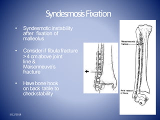 5/12/2018
SyndesmosisFixation
• Syndesmotic instability
after fixation of
malleolus
• Consider if fibula fracture
>4 cm above joint
line &
Maisonneuve’s
fracture
• Havebone hook
on back table to
checkstability
 