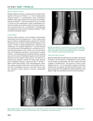 602
Medial malleolus fractures
Medial malleolus fractures usually present as Salter-Harris
type III or IV injuries. If there is ≥ 1 mm of displacement
surgical fixation is recommended, given associations
between these types of fractures and nonunion and phy-
seal bar formation.32,43 We recommend the use of a direct
‘J’ incision on the medial side in order to adequately visu-
alize the medial corner of the mortise and assess anatomi-
cal consistency (Fig. 22). A combination of metaphyseal
and epiphyseal screws achieves adequate stability,44 while
avoiding crossing the physis.
Juvenile Tillaux
Juvenile Tillaux fractures can be treated conservatively
when there is joint incongruency of < 2 mm, using a short
leg cast without weight bearing for a period of 3–4 weeks
followed by two crutches and protected loading for two
weeks.45 If there is greater displacement, reduction and
stabilization are required. Reduction is usually achieved
in a closed manner and stabilization is achieved via a 3.5–
4.0-mm percutaneous screw, which can cross the physis
(Fig. 23). If adequate reduction is not achieved in a closed
manner, a minimal approach should be utilized, avoiding
injury to the anterior tibiofibular ligament and extensive
dissection of the anterior ankle capsule. The decision to
perform this treatment should be made early, because
the consolidation process is advanced after 7–10 days.15
When performing fixation with transepiphyseal screws
the surgeon should consider their removal after the frac-
ture has consolidated, because it has been shown that
the maximum contact pressure increases substantially
with use.46
Salter–Harris type IV injuries
Approximately 25% of ankle fractures are Salter–Harris type
IV injuries.40 In the absence of displacement such injuries
can be treated conservatively, but they usually do entail
a degree of displacement. The presence of step or joint
displacement of > 2 mm necessitates surgery to minimize
residual joint incongruity and physeal bar formation. The
types of approach and stabilization utilized depend on the
patient’s age, the area affected, and the fracture pattern.
Fig. 22  Left ankle of a 12-year-old boy with a medial malleolus
Salter–Harris type IV fracture (A), and postoperative control after
performing open reduction internal fixation with a cannulated
screw, without compromising the physis (B).
Fig. 23  Right ankle of a 14-year-old girl with a juvenile Tillaux fracture with anterior displacement (A, B). Surgical management was
performed using open reduction internal fixation with a transphyseal cannulated screw (C).
 