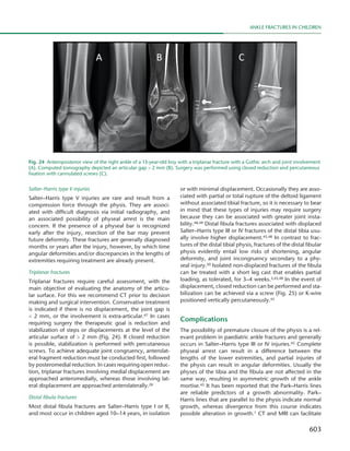 603
Ankle fractures in children
Salter–Harris type V injuries
Salter–Harris type V injuries are rare and result from a
compression force through the physis. They are associ-
ated with difficult diagnosis via initial radiography, and
an associated possibility of physeal arrest is the main
concern. If the presence of a physeal bar is recognized
early after the injury, resection of the bar may prevent
future deformity. These fractures are generally diagnosed
months or years after the injury, however, by which time
angular deformities and/or discrepancies in the lengths of
extremities requiring treatment are already present.
Triplanar fractures
Triplanar fractures require careful assessment, with the
main objective of evaluating the anatomy of the articu-
lar surface. For this we recommend CT prior to decision
making and surgical intervention. Conservative treatment
is indicated if there is no displacement, the joint gap is
< 2 mm, or the involvement is extra-articular.47 In cases
requiring surgery the therapeutic goal is reduction and
stabilization of steps or displacements at the level of the
articular surface of > 2 mm (Fig. 24). If closed reduction
is possible, stabilization is performed with percutaneous
screws. To achieve adequate joint congruency, anterolat-
eral fragment reduction must be conducted first, followed
by posteromedial reduction. In cases requiring open reduc-
tion, triplanar fractures involving medial displacement are
approached anteromedially, whereas those involving lat-
eral displacement are approached anterolaterally.26
Distal fibula fractures
Most distal fibula fractures are Salter–Harris type I or II,
and most occur in children aged 10–14 years, in isolation
or with minimal displacement. Occasionally they are asso-
ciated with partial or total rupture of the deltoid ligament
without associated tibial fracture, so it is necessary to bear
in mind that these types of injuries may require surgery
because they can be associated with greater joint insta-
bility.48,49 Distal fibula fractures associated with displaced
Salter–Harris type III or IV fractures of the distal tibia usu-
ally involve higher displacement.45,48 In contrast to frac-
tures of the distal tibial physis, fractures of the distal fibular
physis evidently entail low risks of shortening, angular
deformity, and joint incongruency secondary to a phy-
seal injury.50 Isolated non-displaced fractures of the fibula
can be treated with a short leg cast that enables partial
loading, as tolerated, for 3–4 weeks.3,45,48 In the event of
displacement, closed reduction can be performed and sta-
bilization can be achieved via a screw (Fig. 25) or K-wire
positioned vertically percutaneously.45
Complications
The possibility of premature closure of the physis is a rel-
evant problem in paediatric ankle fractures and generally
occurs in Salter–Harris type III or IV injuries.45 Complete
physeal arrest can result in a difference between the
lengths of the lower extremities, and partial injuries of
the physis can result in angular deformities. Usually the
physes of the tibia and the fibula are not affected in the
same way, resulting in asymmetric growth of the ankle
mortise.45 It has been reported that the Park–Harris lines
are reliable predictors of a growth abnormality. Park–
Harris lines that are parallel to the physis indicate normal
growth, whereas divergence from this course indicates
possible alteration in growth.1 CT and MRI can facilitate
Fig. 24  Anteroposterior view of the right ankle of a 13-year-old boy with a triplanar fracture with a Gothic arch and joint involvement
(A). Computed tomography depicted an articular gap > 2 mm (B). Surgery was performed using closed reduction and percutaneous
fixation with cannulated screws (C).
 