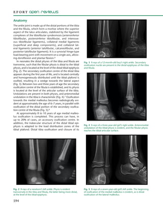 594
Anatomy
The ankle joint is made up of the distal portions of the tibia
and the fibula, which form a mortise where the superior
aspect of the talus articulates, stabilized by the ligament
complexes of the tibiofibular syndesmosis (anteroinferior
tibiofibular, posteroinferior tibiofibular, and interosse-
ous tibiofibular ligaments), collateral medial ligaments
(superficial and deep components), and collateral lat-
eral ligaments (anterior talofibular, calcaneofibular, and
posterior talofibular ligament). It is a synovial hinge-type
load-bearing joint with movement on a single axis, allow-
ing dorsiflexion and plantar flexion.6
In neonates the distal physes of the tibia and fibula are
transverse, such that the fibular physis is distal to the tibial
physis, and is located at the level of the distal tibial epiphysis
(Fig. 2). The secondary ossification centre of the distal tibia
appears during the first year of life, and is located centrally
and homogeneously distributed until the tibial plafond is
ossified, resulting in a wedge towards the lateral aspect
(Fig. 3). Between two and three years of age the secondary
ossification centre of the fibula is established, and its physis
is located at the level of the articular surface of the tibia.
Undulations are present in both physes, and anteromedial
undulation in the tibia is characteristic (Fig. 4).7 Ossification
towards the medial malleolus becomes radiologically evi-
dent at approximately the age of 6–7 years, in parallel with
ossification of the distal portion of the secondary ossifica-
tion centre of the fibula (Fig. 5).8
At approximately 8 to 10 years of age medial malleo-
lus ossification is completed. This process can have, in
up to 20% of cases, an accessory ossification centre. In
addition, the trabecular structure of the distal tibial epi-
physis is adapted to the load distribution zones of the
tibial plafond. Distal tibia ossification and closure of its
Fig. 2  X-rays of a newborn’s left ankle. Physis is evident
transversely in the tibia and fibula, the latter being more distal,
at the level of the tibial epiphysis.
Fig. 3  X-rays of a 12-month-old boy’s right ankle. Secondary
ossification nuclei are present in the distal epiphyses of the tibia
and fibula.
Fig. 4  X-rays of a three-year-old girl’s right ankle. Anteromedial
undulation of the tibial physis is evident, and the fibular physis
reaches the tibial articular surface.
Fig. 5  X-rays of a seven-year-old girl’s left ankle. The beginning
of ossification of the medial malleolus is evident, as is distal
ossification of the lateral malleolus.
 