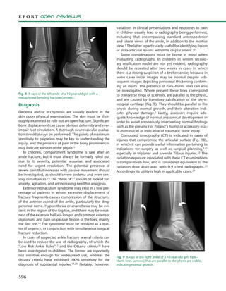 596
Diagnosis
Oedema and/or ecchymosis are usually evident in the
skin upon physical examination. The skin must be thor-
oughly examined to rule out an open fracture. Significant
bone displacement can cause obvious deformity and even
impair foot circulation. A thorough neurovascular evalua-
tion should always be performed. The points of maximum
sensitivity to palpation may be key to understanding the
injury, and the presence of pain in the bony prominences
may indicate a lesion of the physis.3
In children, compartment syndrome is rare after an
ankle fracture, but it must always be formally ruled out
due to its severity, potential sequelae, and associated
need for urgent resolution. The potential presence of
severe pain that increases with passive movement should
be investigated, as should severe oedema and even sen-
sory disturbances.15 The ‘three ‘A’s’ should be looked for:
anxiety, agitation, and an increasing need for analgesia.
Extensor retinaculum syndrome may exist in a low per-
centage of patients in whom excessive displacement of
fracture fragments causes compression of the structures
of the anterior aspect of the ankle, particularly the deep
peroneal nerve. Hypoesthesia or anaesthesia may be evi-
dent in the region of the big toe, and there may be weak-
ness of the extensor hallucis longus and common extensor
digitorum, and pain on passive flexion of the toes, mainly
the first toe.16 The syndrome must be resolved as a mat-
ter of urgency, in conjunction with simultaneous surgical
fracture reduction.
In cases of suspected ankle fracture several criteria can
be used to reduce the use of radiography, of which the
‘Low Risk Ankle Rules’17 and the Ottawa criteria18 have
been investigated in children. The former are reportedly
not sensitive enough for widespread use, whereas the
Ottawa criteria have exhibited 100% sensitivity for the
diagnosis of substantial injuries.19,20 Notably, however,
variations in clinical presentations and responses to pain
in children usually lead to radiography being performed,
including that encompassing standard anteroposterior
and lateral views of the ankle, in addition to the mortise
view.1 The latter is particularly useful for identifying fission
or intra-articular lesions with little displacement.15
Some considerations must be borne in mind when
evaluating radiographs. In children in whom second-
ary ossification nuclei are not yet evident, radiography
should be repeated after two weeks in cases in which
there is a strong suspicion of a broken ankle; because in
some cases initial images may be normal despite sub-
sequent images depicting periosteal thickening confirm-
ing an injury. The presence of Park–Harris lines can also
be investigated. Where present these lines correspond
to transverse rings of sclerosis, are parallel to the physis,
and are caused by transitory calcification of the physi-
ological cartilage (Fig. 9). They should be parallel to the
physis during normal growth, and their alteration indi-
cates physeal damage.1 Lastly, assessors require ade-
quate knowledge of normal anatomical development in
order to avoid erroneously interpreting normal findings
such as the presence of Poland’s hump or accessory ossi-
fication nuclei as indicative of traumatic bone injury.
Computed tomography (CT) is indicated in cases of
injuries that compromise the articular surface (Fig. 10),
in which it can provide useful information pertaining to
indications for surgery as well as surgical planning,3,21
especially in triplanar and juvenile Tillaux injuries.22 The
radiation exposure associated with these CT examinations
is comparatively low, and is considered equivalent to the
radiation dose associated with 0.9 chest radiographs.23
Accordingly its utility is high in applicable cases.24
Fig. 8  X-rays of the left ankle of a 10-year-old girl with a
metaphyseal bending fracture (arrows).
Fig. 9  X-rays of the right ankle of a 10-year-old girl. Park–
Harris lines (arrows) that are parallel to the physis are visible,
indicating normal growth.
 