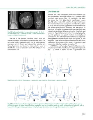 597
Ankle fractures in children
The role of MRI remains uncertain, and it does not
have a substantial influence on therapeutic decisions.25 It
can reveal hidden fractures, and it can be used to assess
premature physis closure and injury of the articular car-
tilage, ligaments, and tendons. It can also be used to
identify the cause of persistent pain after a fracture has
consolidated.15,26
Classification
Johnson and Fahl27 developed the first classification sys-
tem for paediatric ankle fractures in 1957, dividing them
into three main groups (Fig. 11). For injuries that affect
the physis, the 1963 Salter–Harris classification system
(Fig. 12) is the most widely used for all segments because
it is simple and provides a prognosis based on the pattern
of injury.28 In that system type I fractures extend through
the growth plate without involving the metaphysis or
epiphysis, type II fractures extend through the physis and
metaphysis, and type III fractures involve the physis and
epiphysis. Type IV fractures involve the metaphysis, phy-
sis, and epiphysis, and type V fractures involve physeal
compression. The risk of physeal arrest is lower in patients
with type I and II injuries than in those with type III, IV, and
V injuries. Types III–V usually require reduction and inter-
nal fixation, which reduces joint surface inconsistency and
reduces the risk of physeal bar formation.29,30
In 1978, Dias and Tachdjian31 published their own clas-
sification system for ankle fractures in paediatric patients
(Fig. 13), which is based on the Lauge-Hansen and
Fig. 10  Radiography (A) and computed tomography (B, C) of
the right ankle of an 11-year-old girl with a Salter–Harris type III
fracture with joint involvement.
Fig. 11  Johnson and Fahl classification: 1, abduction type; 2, plantar flexion type; 3, adduction type.27
Fig. 12  Salter–Harris classification: type I, complete separation of the epiphysis from the metaphysis through the physis; type II,
fracture line along the physis and a portion of metaphysis; type III, fracture line along the physis and a portion of epiphysis; type IV,
fracture line through epiphysis, physis and metaphysis; type V, crushing force through the epiphysis to the physis.28
 