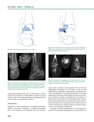 600
square bone fragment (Fig. 19). In cases that occur closer
to the end of growth a Salter-Harris IV pattern may be
evident, with a small lateral triangular metaphyseal frag-
ment, similar to an adult Tillaux lesion.32
Treatment
Regardless of their classification, non-displaced fractures
require conservative treatment, including immobiliza-
tion of the segment and discharge with two crutches,
unless there is rotation of the segment. We recommend
radiological examination at 7–10 days to rule out late
displacement, especially in high-energy mechanism frac-
tures. Immobilization is usually maintained for 4–6 weeks
depending on the age of the patient and the type of frac-
ture, followed by load as tolerated for two weeks.32,37
Boutis et al38 concluded that a removable ankle immobi-
lizer is more effective than a short leg cast in terms of func-
tional recovery, and is associated with an earlier return to
normal activities and a greater degree of patient accept-
ance, as well as being cost-efficient.
Fractures involving displacement at the physeal or
joint level may require management by closed reduction.
Fig. 16  Extra-articular triplanar fracture pattern.
Fig. 17  Computed tomography of the left ankle of a 13-year-old
girl with an extra-articular triplanar fracture. A sagittal fracture
that compromises the medial malleolus is visible in the coronal
(A) and axial sections (B), and a coronal metaphyseal pattern is
evident in the sagittal section (C).
Fig. 18  Juvenile Tillaux fracture pattern. The anterior tibiofibular
ligament is inserted into the avulsed fragment of the anterior
distal tubercle of the tibia (arrow).
Fig. 19  Computed tomography of the right ankle of a 15-year-
old boy depicting a juvenile Tillaux fracture. A square-shaped
fragment is observed in all sections.
 