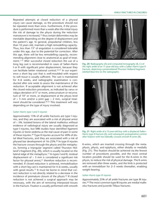 601
Ankle fractures in children
Repeated attempts at closed reduction of a physeal
injury can cause damage, so the procedure should not
be repeated more than once. Furthermore, if the proce-
dure is performed more than a week after the initial injury
the risk of damage to the physis during the reduction
manoeuvre is increased,15 thus certain deformities may be
inevitable depending on the degree of displacement and
the patient’s age. In general, prepubertal children, less
than 10 years old, maintain a high remodelling capacity.
Thus, less than 15° of angulation is considered tolerable
under this age, due to the potential for correction. After
this age, there will be less remodelling capacity, recom-
mending alignment close to anatomical as goal of treat-
ment.1,14 After successful closed reduction the use of a
long leg cast is recommended in cases of Salter–Harris
I or II with significant prior displacement, because they
can facilitate better rotational control.32,37 In our experi-
ence a short leg cast that is well-moulded with respect
to soft tissue is usually sufficient. The cast is maintained
for 4–6 weeks, and radiographic examination is con-
ducted after one week to assess the maintenance of the
reduction. If acceptable alignment is not achieved after
the closed reduction procedure, as indicated by varus or
valgus deviation of 5° or more, antecurvatum or recurva-
tum of 10° or more, or displacement at the physis level
of > 3 mm and/or a joint gap > 2 mm, surgical treat-
ment should be considered.29,32 This treatment will vary
depending on the type of injury involved.
Salter–Harris type I and II injuries
Approximately 15% of all ankle fractures are type I inju-
ries, and they are associated with a risk of physeal arrest
of < 5%. Isolated lesions of the lateral malleolus without
evidence of radiological injury are usually diagnosed as
type I injuries, but MRI studies have identified ligament
injuries or bone oedema as the real cause of pain in some
of these injuries.39 Type II injuries account for 40% of dis-
tal tibial fractures, and they are associated with a risk of
physeal bar development of 16–25%.40 In type II injuries
the fracture crosses through the physis and the metaphy-
sis, forming a triangular segment called Thurston Hol-
land’s fragment (Fig. 20), which is usually located on the
lateral edge of the metaphysis.15 In types I and II, residual
displacement of > 3 mm is considered a significant risk
factor for physeal arrest,41 therefore reduction is recom-
mended. If closed reduction is achieved, immobilization
with a short leg cast is maintained for 4–6 weeks, usually
with good results.15 It must be borne in mind that cor-
rect reduction is not directly related to a decrease in the
incidence of premature closure of the physis.42 If closed
reduction is not achieved a surgical approach may be
necessary, with the aim of removing interposed tissues
in the fracture. Fixation is usually performed with smooth
K-wires, which are inserted crossing through the meta-
physis, physis, and epiphysis, either distally or medially
(Fig. 21). This fixation should be achieved via the fewest
number of procedures possible, and the most central
location possible should be used for the K-wires in the
physis, to reduce the risk of physical damage. The K-wires
are removed after three weeks, and the limb is protected
with an immobilizer for 2–3 weeks thereafter, enabling
weight bearing.
Salter–Harris type III injuries
Approximately 25% of all ankle fractures are type III inju-
ries.40 The most common type III injuries are medial malle-
olus fractures and juvenile Tillaux fractures.
Fig. 20  Radiography (A) and computed tomography (B, C) of
the right ankle of an 11-year-old boy with a Salter–Harris type II
fracture, depicting a posterolateral Thurston Holland fragment
(dotted blue line on the radiograph).
Fig. 21  Right ankle of a 13-year-old boy with a displaced Salter–
Harris type II fracture (A), and subsequent postoperative control
after fixation with two laterally crossed smooth K-wires (B).
 