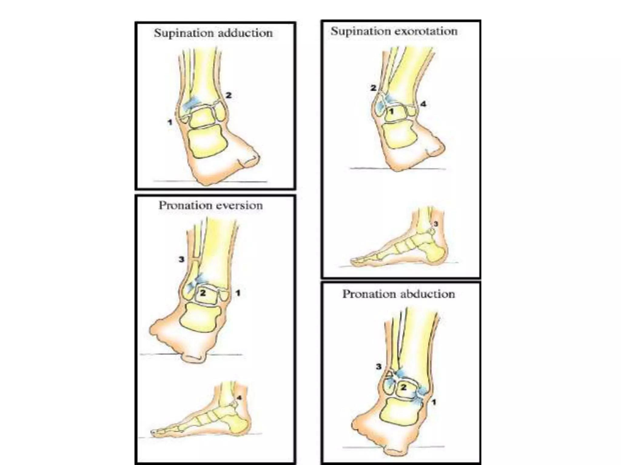 Ankle fractures | PPTX