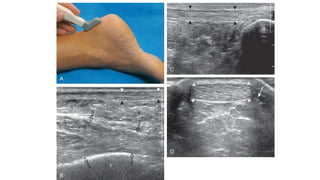 Musculoskeletal Ultrasound guided Ankle injection.pptx