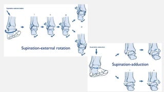 Supinated External Rotation ankle injuries(15-12-2022) copy-1.pptx ppf | PPTX