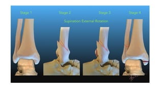 Ankle Rptation Injury injuries around the ankle joint , orthopaedics | PPTX