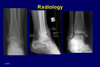 Ankle Rx Ankle injury | PPT