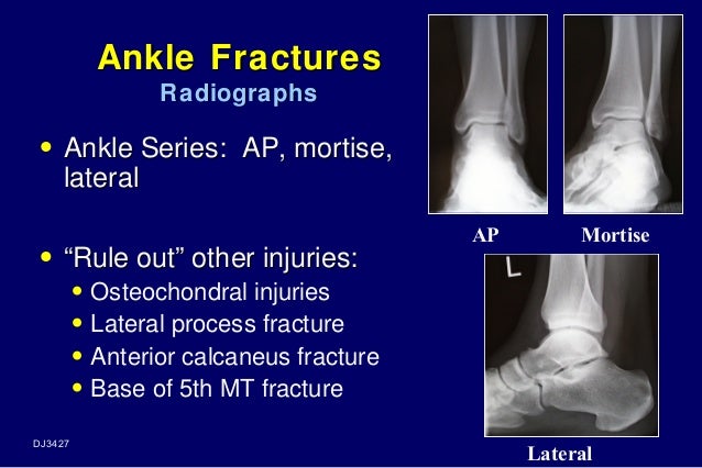 Ankle Injury