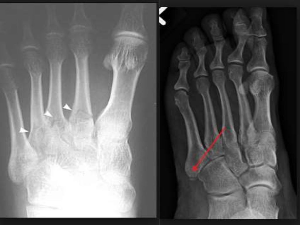 All Types Of Ankle Fracture By Kajal