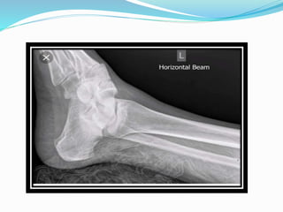 RADIOGRAPHIC VIEWS OF ANKLE JOINT | PPTX