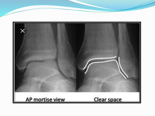 Ankle Rx RADIOGRAPHIC VIEWS OF ANKLE JOINT | PPTX