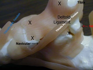 Tibia
X
X
X
Navicular ---
-- Tal
Deltoid
Ligament
X
 