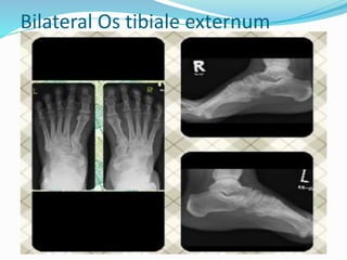 Bilateral Os tibiale externum
 