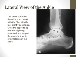 Lateral View of the Ankle
• The lateral surface of
  the ankle is in contact
  with the film, with the
  foot slightly dorsiflexed.
  Cross the opposite leg
  over the leg being
  examined, and support
  the opposite knee to
  avoid rotation of the
  ankle.
 