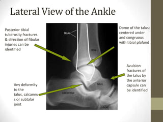 Lateral View of the Ankle
Posterior tibial               Dome of the talus:
tuberosity fractures           centered under
& direction of fibular         and congruous
injuries can be                with tibial plafond
identified



                                   Avulsion
                                   fractures of
                                   the talus by
                                   the anterior
     Any deformity                 capsule can
     to the                        be identified
     talus, calcaneu
     s or subtalar
     joint
 