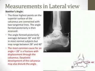 Measurements in Lateral view
Boehler’s Angle:
• The three highest points on the
  superior surface of the
  calcaneus are connected with
  two tangential lines. The angle
  formed posteriorly is then
  assessed.
• The angle formed posteriorly
  averages between 30° and 35°
  in most normal subjects but
  may range between 28° and 40°
• The most common cause for an
  angle < 28° is a fracture with
  displacement through the
  calcaneus. Dysplastic
  development of the calcaneus
  may also disturb the angle.
 