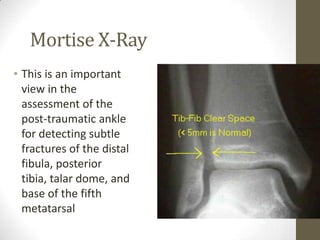 Mortise X-Ray
• This is an important
  view in the
  assessment of the
  post-traumatic ankle
  for detecting subtle
  fractures of the distal
  fibula, posterior
  tibia, talar dome, and
  base of the fifth
  metatarsal
 