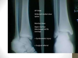 AP View:
Widened medial clear
space


Mortise View:
Open mortise
(decreased tib-fib
overlap)


= Syndesmotic injury


= Surgical referral
 