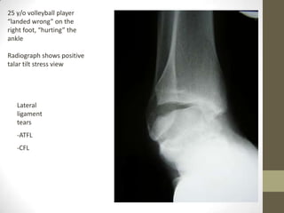 25 y/o volleyball player
“landed wrong” on the
right foot, “hurting” the
ankle

Radiograph shows positive
talar tilt stress view




   Lateral
   ligament
   tears
   -ATFL
   -CFL
 
