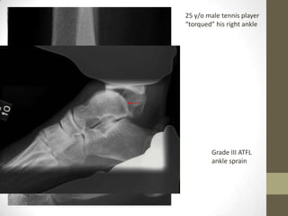 25 y/o male tennis player
“torqued” his right ankle




        Grade III ATFL
        ankle sprain
 