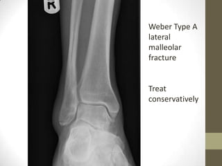 Weber Type A
lateral
malleolar
fracture


Treat
conservatively
 