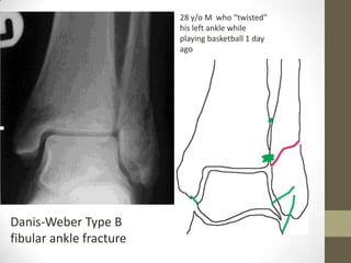 28 y/o M who “twisted”
                         his left ankle while
                         playing basketball 1 day
                         ago




Danis-Weber Type B
fibular ankle fracture
 