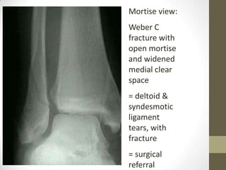 Mortise view:
Weber C
fracture with
open mortise
and widened
medial clear
space
= deltoid &
syndesmotic
ligament
tears, with
fracture
= surgical
referral
 