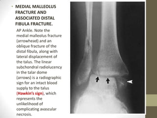 • MEDIAL MALLEOLUS
  FRACTURE AND
  ASSOCIATED DISTAL
  FIBULA FRACTURE.
  AP Ankle. Note the
  medial malleolus fracture
  (arrowhead) and an
  oblique fracture of the
  distal fibula, along with
  lateral displacement of
  the talus. The linear
  subchondral radiolucency
  in the talar dome
  (arrows) is a radiographic
  sign for an intact blood
  supply to the talus
  (Hawkin’s sign), which
  represents the
  unlikelihood of
  complicating avascular
  necrosis.
 