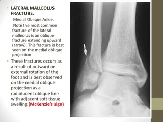 • LATERAL MALLEOLUS
  FRACTURE.
   Medial Oblique Ankle.
   Note the most common
  fracture of the lateral
  malleolus is an oblique
  fracture extending upward
  (arrow). This fracture is best
  seen on the medial oblique
  projection
• These fractures occurs as
  a result of outward or
  external rotation of the
  foot and is best observed
  on the medial oblique
  projection as a
  radiolucent oblique line
  with adjacent soft tissue
  swelling (McKenzie’s sign)
 