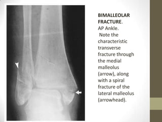 BIMALLEOLAR
FRACTURE.
AP Ankle.
 Note the
characteristic
transverse
fracture through
the medial
malleolus
(arrow), along
with a spiral
fracture of the
lateral malleolus
(arrowhead).
 
