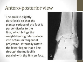 Antero-posterior view
The ankle is slightly
dorsiflexed so that the
plantar surface of the foot is
perpendicular to the
film, which brings the
weight-bearing talar surface
into optimum tangential
projection. Internally rotate
the lower leg so that a line
through the malleoli is
parallel with the film surface.
 