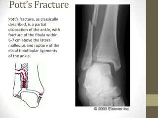 Pott’s Fracture
Pott’s fracture, as classically
described, is a partial
dislocation of the ankle, with
fracture of the fibula within
6-7 cm above the lateral
malleolus and rupture of the
distal tibiofibular ligaments
of the ankle.
 