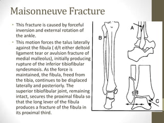 Maisonneuve Fracture
• This fracture is caused by forceful
  inversion and external rotation of
  the ankle.
• This motion forces the talus laterally
  against the fibula ( d/t either deltoid
  ligament tear or avulsion fracture of
  medial malleolus), initially producing
  rupture of the inferior tibiofibular
  syndesmosis. As the force is
  maintained, the fibula, freed from
  the tibia, continues to be displaced
  laterally and posteriorly. The
  superior tibiofibular joint, remaining
  intact, secures the proximal fibula so
  that the long lever of the fibula
  produces a fracture of the fibula in
  its proximal third.
 