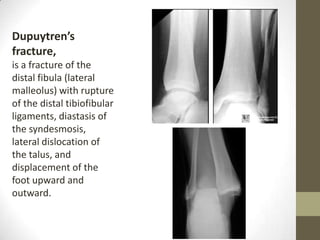 Dupuytren’s
fracture,
is a fracture of the
distal fibula (lateral
malleolus) with rupture
of the distal tibiofibular
ligaments, diastasis of
the syndesmosis,
lateral dislocation of
the talus, and
displacement of the
foot upward and
outward.
 