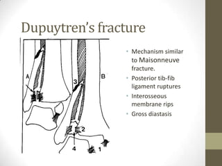 Dupuytren’s fracture
                • Mechanism similar
                  to Maisonneuve
                  fracture.
                • Posterior tib-fib
                  ligament ruptures
                • Interosseous
                  membrane rips
                • Gross diastasis
 